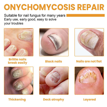 Image showcasing various types of nail damage with text ononychomycosis repair, highlighting fungal nail repair patches.